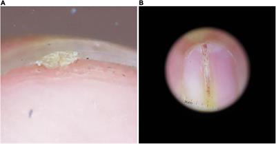 Expression patterns of hair-related keratins and epithelial keratins in onychopapilloma: The significance of clarifying the origin of onychopapilloma